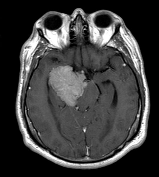 File:Cerebellopontine angle meningioma (Radiopaedia 24459-24764 Axial T1 C+ 10).jpg