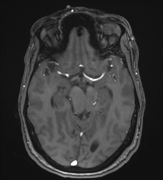 File:Cerebellopontine angle meningioma (Radiopaedia 72983-83680 Axial MRA 51).jpg