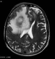 Cerebral abscesses secondary to contusions (Radiopaedia 5201-6968 Axial T2 3).jpg