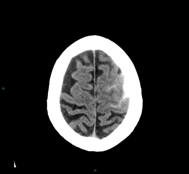 File:Cerebral amyloid angiopathy-associated lobar intracerebral hemorrhage (Radiopaedia 58376-65511 Axial non-contrast 12).jpg