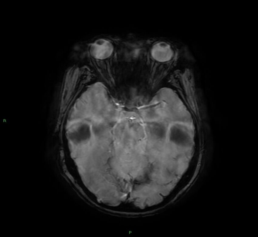 Cerebral amyloid angiopathy-associated lobar intracerebral hemorrhage (Radiopaedia 58378-65517 Axial SWI 26).jpg