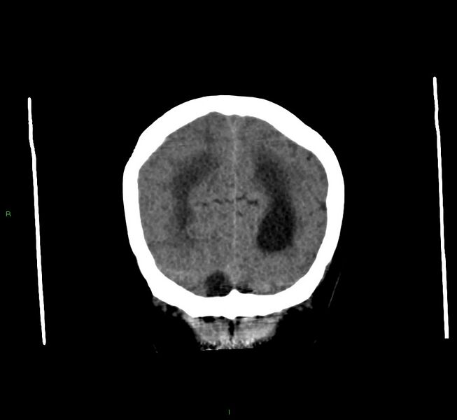 File:Cerebral amyloid angiopathy-associated lobar intracerebral hemorrhage (Radiopaedia 58560-65723 Coronal non-contrast 15).jpg