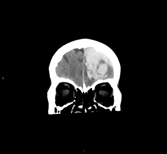 File:Cerebral amyloid angiopathy-associated lobar intracerebral hemorrhage (Radiopaedia 58561-65724 Coronal non-contrast 51).jpg