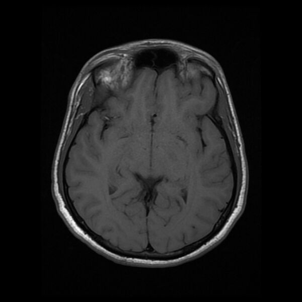 File:Cerebral fat embolism (Radiopaedia 37510-39363 Axial T1 13).jpg