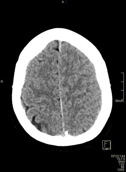 File:Cerebral venous sinus thrombosis (Radiopaedia 91329-108965 Axial non-contrast 41).jpg