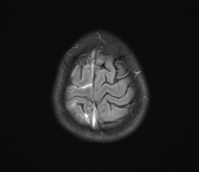 File:Cerebral venous thrombosis (Radiopaedia 71207-81504 Axial FLAIR 23).jpg
