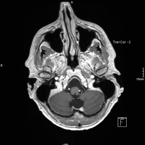 File:Cervical dural CSF leak on MRI and CT treated by blood patch (Radiopaedia 49748-54995 Axial T1 C+ 19).jpg