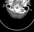 Cervical dural CSF leak on MRI and CT treated by blood patch (Radiopaedia 49748-54996 B 7).png