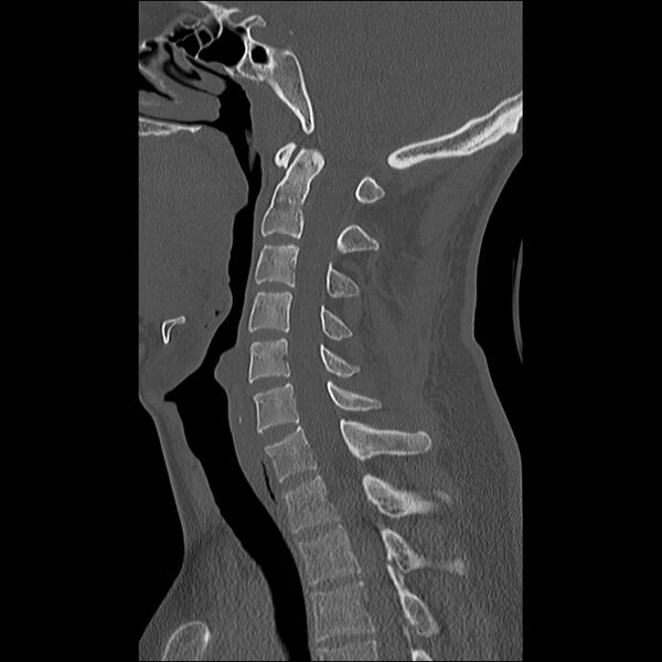 File:Cervical facet fracture and anterior discoligamentous injury (Radiopaedia 32139-33083 Sagittal bone window 19).jpg
