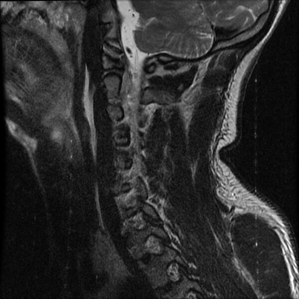 File:Cervical flexion teardrop fracture with cord hemorrhage (Radiopaedia 32497-33455 Sagittal T2 13).jpg