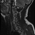 Cervical flexion teardrop fracture with cord hemorrhage (Radiopaedia 32497-33455 Sagittal T2 15).jpg
