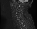 Cervical schwannoma (Radiopaedia 72399-82934 Sagittal STIR 12).jpg