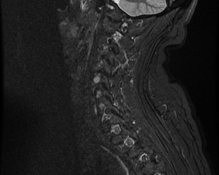File:Cervical schwannoma (Radiopaedia 72399-82934 Sagittal STIR 12).jpg