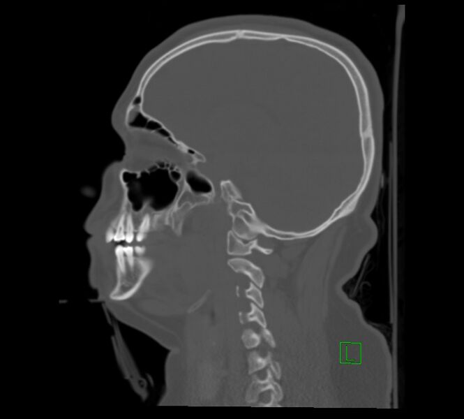 File:Cervical spine fracture - hyperflexion injury (Radiopaedia 66184-75364 A 19).jpg