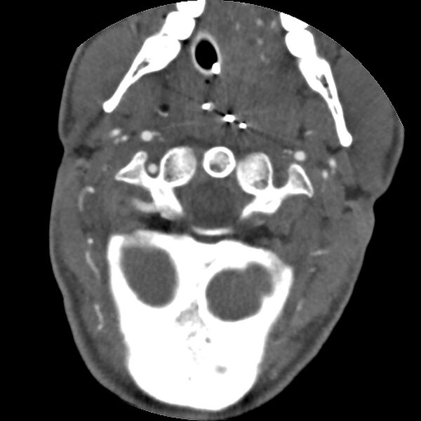File:Cervical spine fractures with vertebral artery dissection (Radiopaedia 32135-33078 D 66).jpg