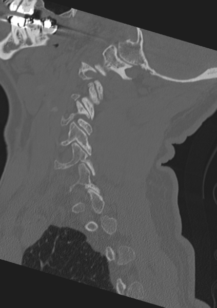 File:Cervical spine fractures with vertebral artery dissection (Radiopaedia 53296-59268 Sagittal bone window 51).png