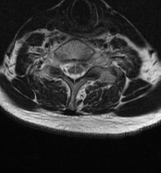 File:Cervical spondylodiscitis (Radiopaedia 81362-95110 Axial T2 15).jpg