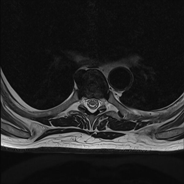 File:Cervical tumor-like myelopathy due to Type V dAVF (Radiopaedia 82461-96604 D 22).jpg