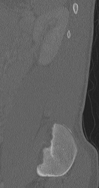 File:Chance fracture (Radiopaedia 40360-42912 Sagittal bone window 17).png
