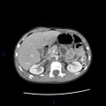 Chance fracture with duodenal and pancreatic lacerations (Radiopaedia 43477-46864 A 7).jpg