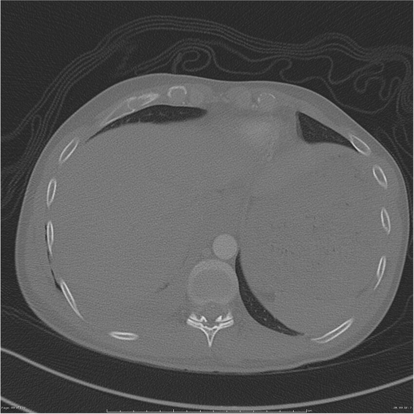 Chest and abdomen multi-trauma (Radiopaedia 26294-26425 bone window 88).jpg