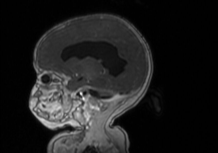 Chiari III malformation with occipital encephalocele (Radiopaedia 79446-92559 Sagittal T1 C+ mpr 43).jpg