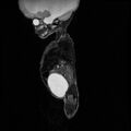 Chiari II malformation with spinal meningomyelocele (Radiopaedia 23550-23652 Sagittal T2 1).jpg