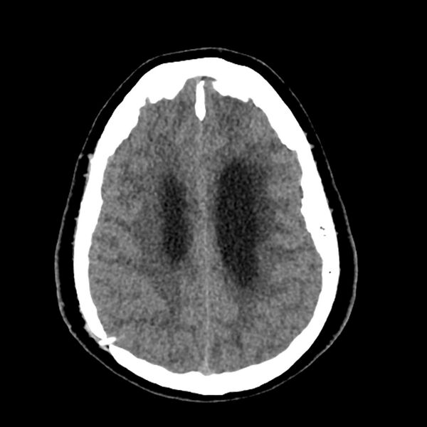 File:Chiasmatic-hypothalamic juvenile pilocytic astrocytoma (Radiopaedia 78533-91237 Axial non-contrast 42).jpg