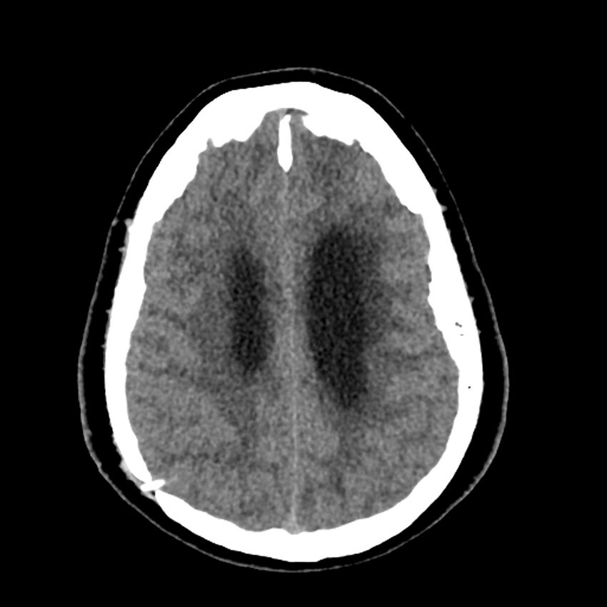 Chiasmatic-hypothalamic juvenile pilocytic astrocytoma (Radiopaedia 78533-91237 Axial non-contrast 42).jpg