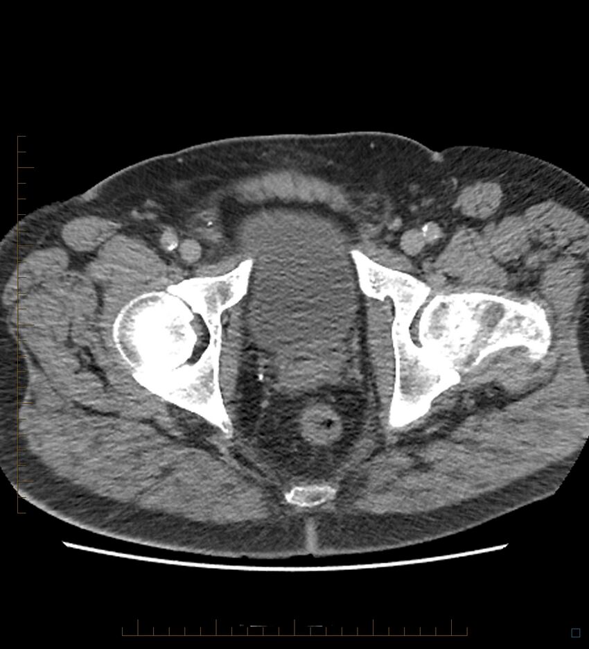 Chicken bone in anal canal (Radiopaedia 51490-57253 Axial non-contrast 6).jpg