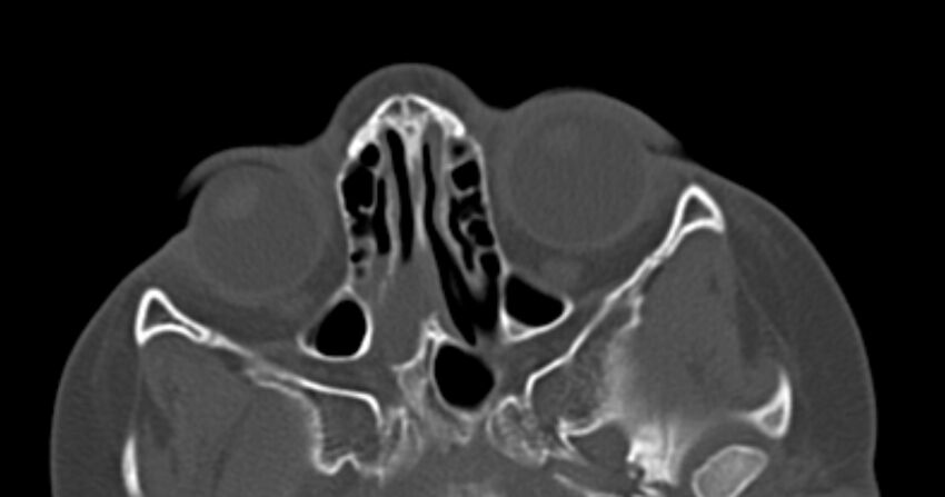 Choanal atresia (Radiopaedia 51295-56972 Axial bone window 36).jpg