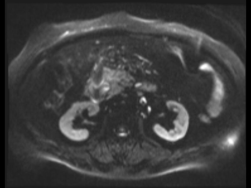 File:Choledocholithiasis causing intrahepatic biliary duct dilation (Radiopaedia 39908-42369 Axial T2 SPAIR 31).jpg