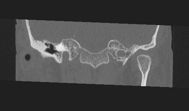 File:Cholesteatoma (Radiopaedia 10742-11203 Coronal bone window 4).jpg