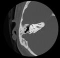 Cholesteatoma (Radiopaedia 20296-20217 bone window 31).jpg