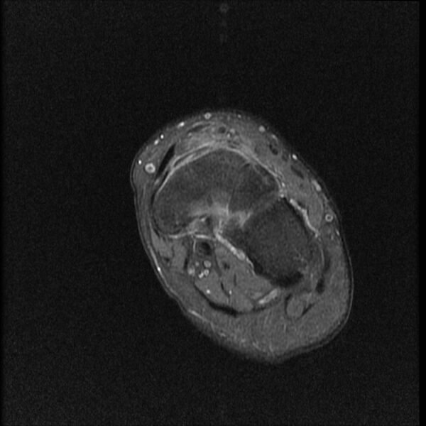 File:Chondroblastoma - midfoot (Radiopaedia 64831-73765 E 12).jpg