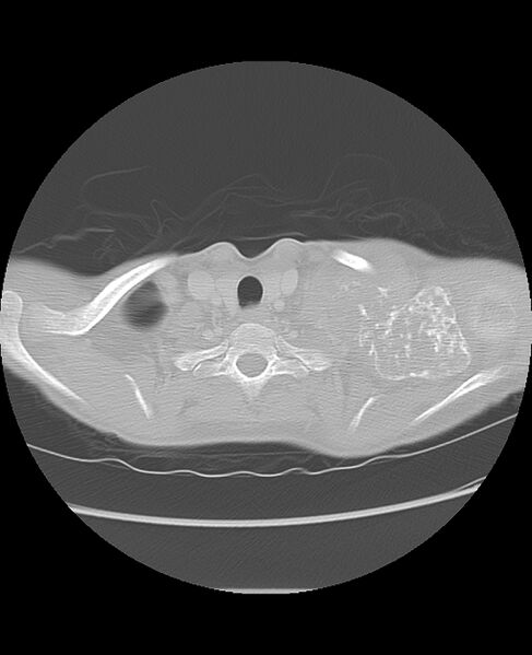 File:Chondrosarcoma (Radiopaedia 79427-92532 Axial lung window 3).jpg