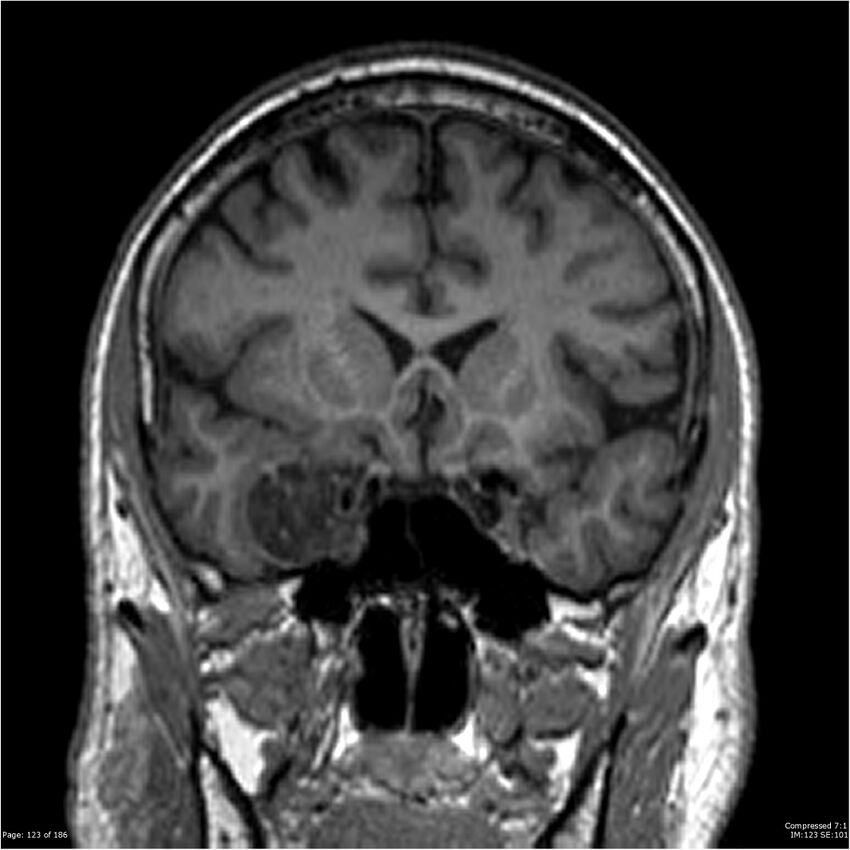 Chondrosarcoma of skull base- grade II (Radiopaedia 40948-43654 Coronal T1 44).jpg