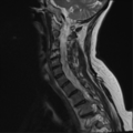 Chordoma (C4 vertebra) (Radiopaedia 47561-52189 Sagittal T2 4).png