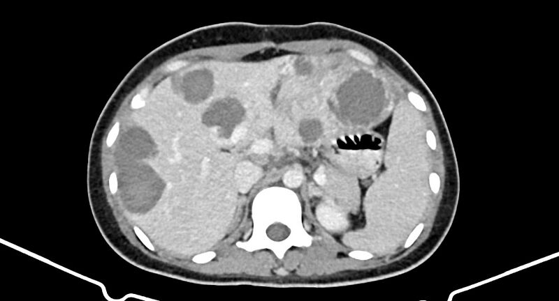 File:Choriocarcinoma liver metastases (Radiopaedia 74768-85766 A 68).jpg