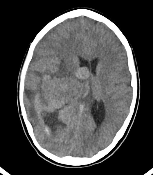 File:Choroid plexus carcinoma (Radiopaedia 91013-108552 Axial non-contrast 34).jpg