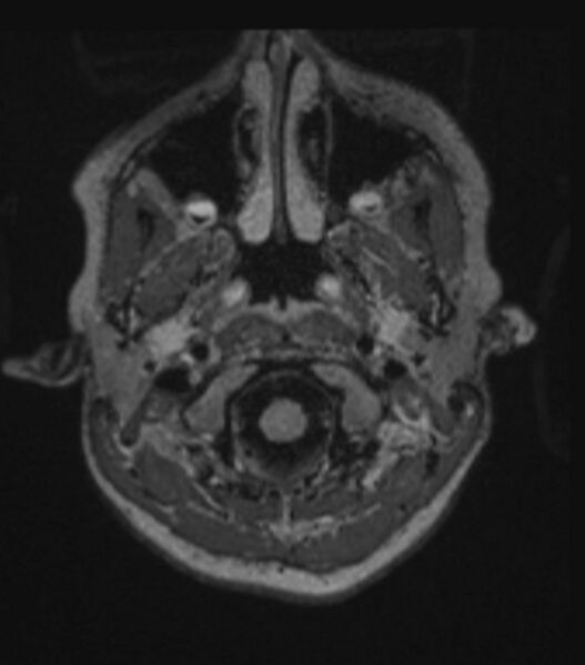 File:Choroid plexus carcinoma (Radiopaedia 91013-108553 Axial FLAIR C+ 73).jpg