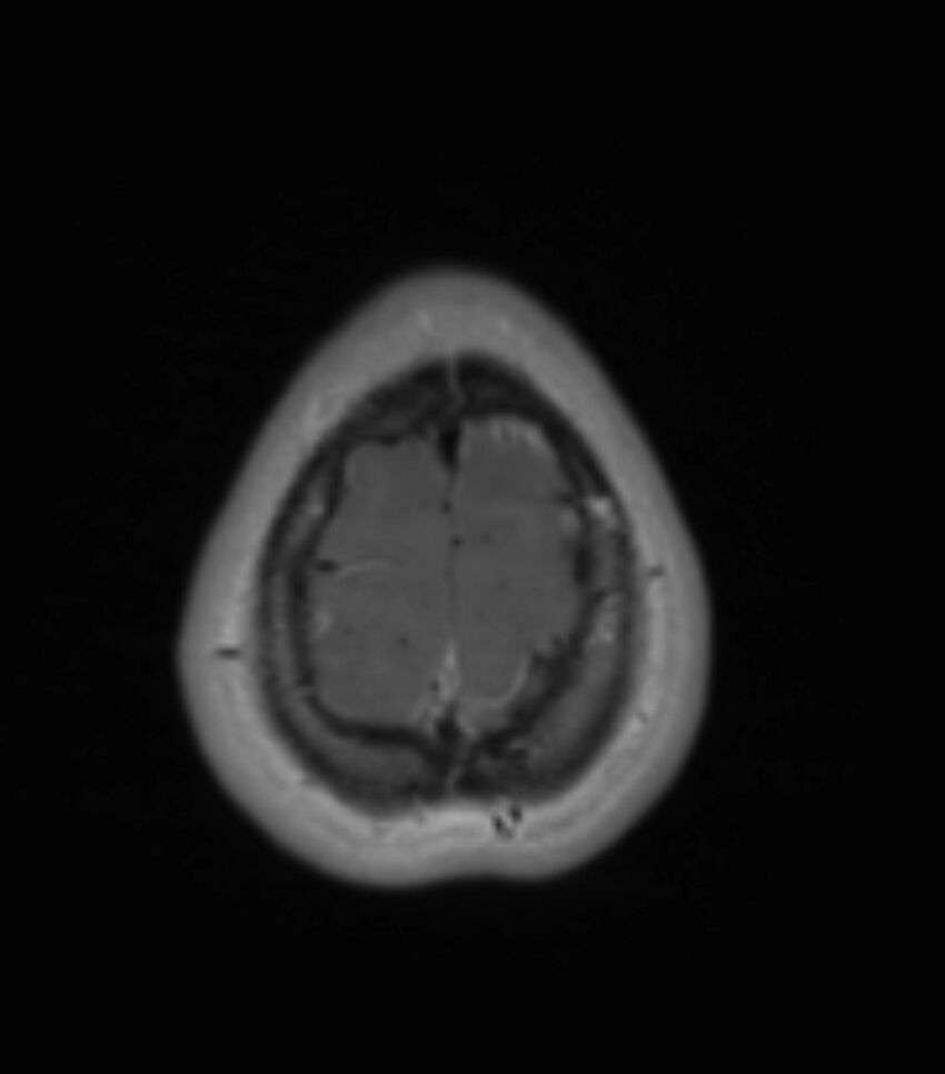 Choroid plexus carcinoma (Radiopaedia 91013-108553 Axial T1 C+ 197).jpg