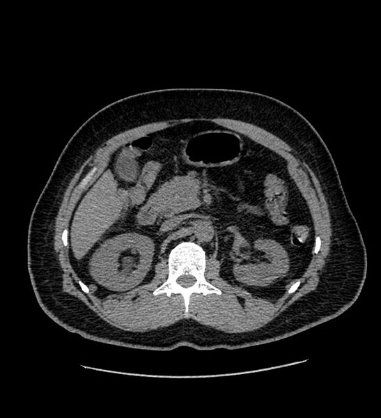 File:Chromophobe renal cell carcinoma (Radiopaedia 84337-99693 Axial non-contrast 47).jpg