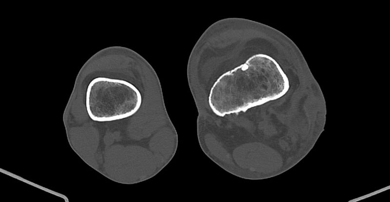 File:Chronic osteomyelitis (with sequestrum) (Radiopaedia 74813-85822 Axial non-contrast 171).jpg