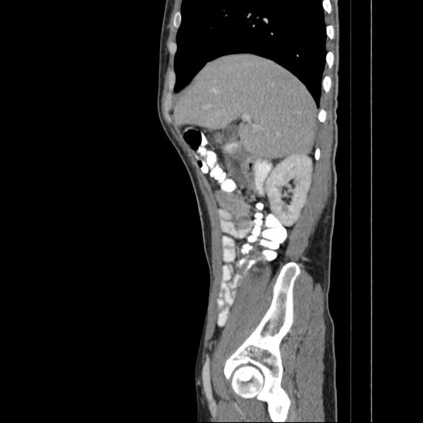 File:Chronic pancreatitis (Radiopaedia 21022-20949 D 15).jpg