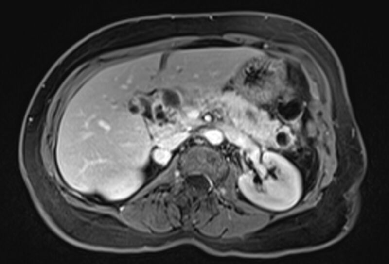 File:Chronic pancreatitis - pancreatic duct calculi (Radiopaedia 71818-82250 Axial T1 C+ fat sat 27).jpg
