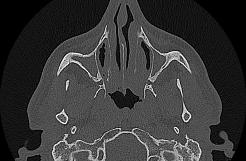 File:Chronic rhinosinusitis (Radiopaedia 65079-74075 Axial bone window 22).jpg