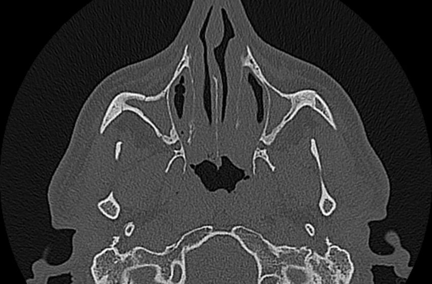 Chronic rhinosinusitis (Radiopaedia 65079-74075 Axial bone window 22).jpg