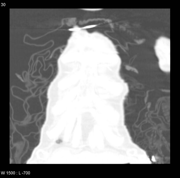 File:Clagett thoracotomy (Radiopaedia 8568-9403 Coronal lung window 30).jpg