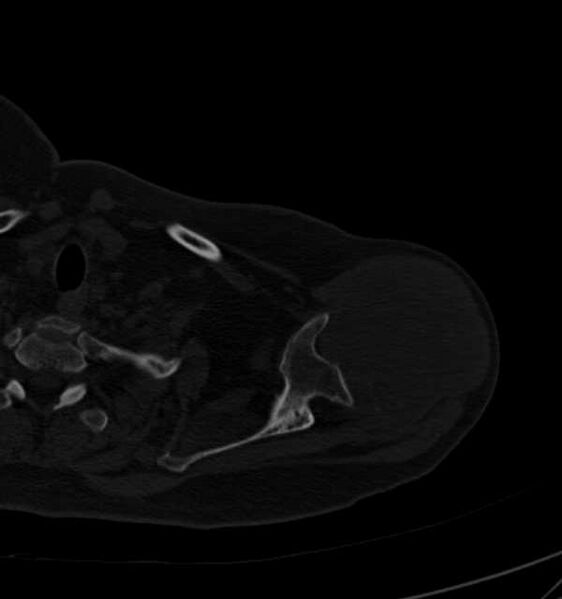 File:Clear cell chondrosarcoma - humerus (Radiopaedia 63104-71612 Axial bone window 26).jpg
